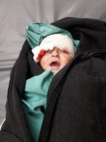 طفلة فلسطينية ضحية الغارات الإسرائيلية