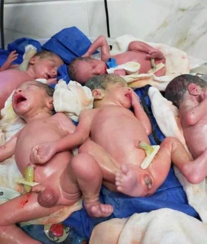 سيدة تضع 5 توائم في ولادة قيصرية بمستشفى منشاوى طنطا  .. حالتهم جيدة