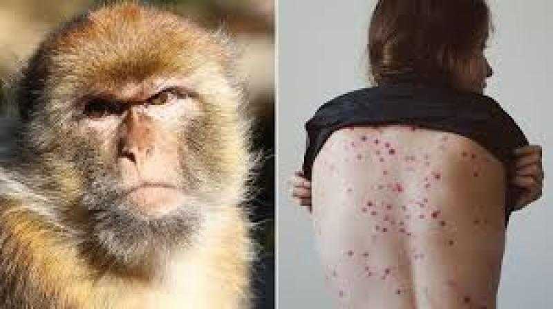 وزير الصحة : حَصر المخالطين للمصاب بجدري القرود.. ومتابعتهم لمدة 21 يومًا